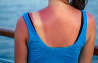 Cuándo una quemadura de sol requiere atención médica inmediata