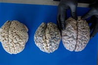 Identifican seis metabolitos clave para detectar la demencia