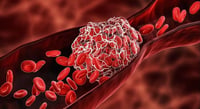 Los stents pueden aliviar los síntomas a largo plazo de la trombosis venosa profunda