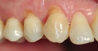 ¿Te duelen los dientes con el frío? Estas son las razones más comunes