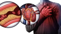 Arterias obstruidas: los síntomas poco conocidos que pueden manifestarse