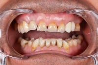 Bruxismo: las señales que delatan que rechinas los dientes