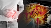 Del hígado graso a la cirrosis: la evolución silenciosa que puede dañar tu salud