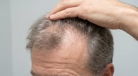 10 causas de la caída del cabello que pueden revelar un problema de salud