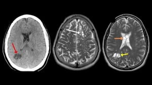 Un hombre en Florida, que experimentaba migrañas cada vez más intensas, fue diagnosticado con larvas de tenia parásita en el cerebro, según un informe reciente