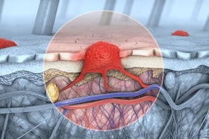 El herpes genital es una infección de transmisión sexual muy extendida, afectando a más de 846 millones de personas en todo el mundo, con una prevalencia