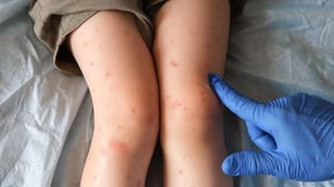 En hospitales de todo el mundo, infecciones que antes se resolvían con tratamientos simples ahora desafían incluso a los medicamentos más avanzados.
