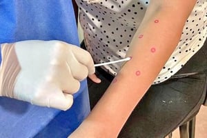 Una nueva variante de mpox fue detectada en Reino Unido en un paciente que viajó a Asia, lo que reaviva la vigilancia internacional sobre este virus.