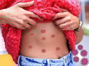 El virus Mpox —antes llamado viruela símica— continúa atravesando fronteras de manera inesperada, poniendo a prueba los sistemas sanitarios de varios países.