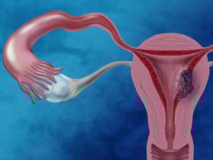 El cáncer de endometrio se ha convertido en el tumor maligno ginecológico más frecuente, una situación que contrasta con el desconocimiento que todavía