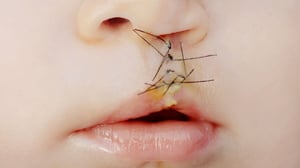 El uso de un bloqueo nervioso previo a la cirugía para reparar el paladar hendido podría disminuir de forma importante, o incluso evitar, la necesidad