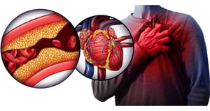 La depresión y la ansiedad se asocian desde hace tiempo con un mayor riesgo de infarto, enfermedades del corazón y accidentes cerebrovasculares, y ahora