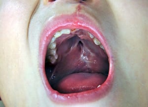 Aplicar un bloqueo nervioso antes de la cirugía para corregir el paladar hendido podría disminuir de forma importante, e incluso evitar, la necesidad