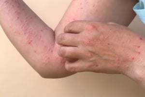 El brote de sarampión en Jalisco alcanza mil 20 contagios acumulados, principalmente en jóvenes, y autoridades duplican brigadas de vacunación para contener