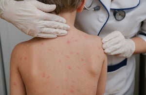 La Secretaría de Salud confirmó 28 muertes por sarampión en México, con un caso adicional en análisis, y destacó que la mayoría no estaba vacunada.