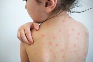 La Secretaría de Salud de Tamaulipas confirma que no hay casos positivos de sarampión y mantiene vigilancia epidemiológica ante posibles contagios sospechosos.