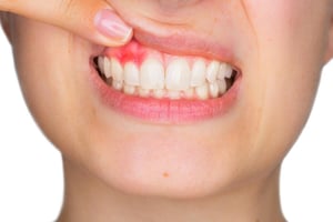 Con frecuencia, al hablar de prevención cardiovascular, se piensa de inmediato en la hipertensión, el colesterol elevado o la glucosa en sangre.