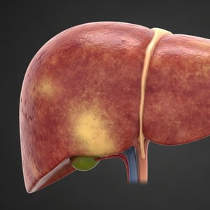 La enfermedad por hígado graso constituye un problema de salud a nivel mundial. Se estima que alrededor del 25% de la población presenta algún grado de esta