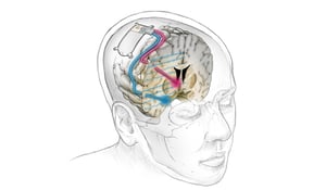 El llamado marcapasos cerebral ya no pertenece al terreno de la ciencia ficción: es una herramienta terapéutica real que podría transformar la vida de personas