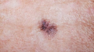 Observa con atención tus manos, uñas y las plantas de los pies. La aparición de manchas oscuras podría ser una señal de alerta frente al melanoma, una forma