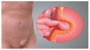 Un bulto o incomodidad en la zona de la ingle suele ser uno de los primeros indicios de una hernia inguinal, una afección bastante común que afecta a millones