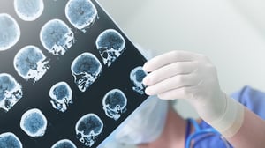 Un fármaco ampliamente utilizado en medicina ha recibido una nueva indicación para tratar el infarto cerebral, una de las principales causas de muerte