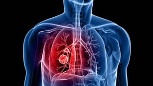El cáncer de pulmón continúa siendo la principal causa de muerte por cáncer en el mundo, de acuerdo con la OMS, con más de 2 millones de casos nuevos cada año.