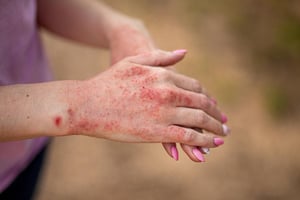 Las personas que viven con enfermedades autoinmunes pueden enfrentar un mayor riesgo de desarrollar cáncer, aunque ese peligro parece disminuir