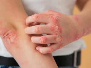 La urticaria crónica es un problema de la piel que se caracteriza por la aparición repetida de ronchas, picazón e inflamación. Debido a que los brotes