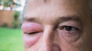 El angioedema hereditario (AEH) es una enfermedad rara que provoca episodios de inflamación repentina y dolorosa en distintas partes del cuerpo, como la piel,