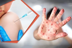 Sarampión repunta en Coahuila con 14 nuevos contagios. Van 69 en 2026, sin fallecidos. Autoridades investigan 250 casos probables.  La Secretaría de Salud