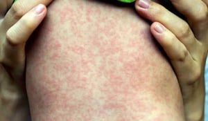 El sarampión es una enfermedad viral muy contagiosa que suele identificarse por el característico sarpullido rojo en la piel. Sin embargo, antes