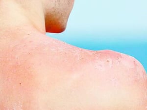 Especialistas y sector Saluds alertan que el daño solar acumulado desde la infancia aumenta el riesgo de lesiones malignas en la piel.  El incremento