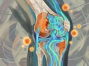 La medicina regenerativa está avanzando con una propuesta innovadora para tratar la artrosis de rodilla.  Esta nueva técnica se basa en la reprogramación