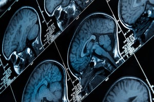 La esclerosis múltiple es una enfermedad neurológica crónica que afecta al sistema nervioso central y ocurre cuando el sistema inmunitario ataca la mielina,