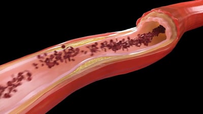 Arterioesclerosis: la enfermedad que estrecha tus arterias sin dar señales