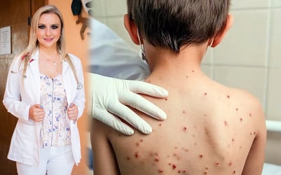 Dra. pediatra descarta contagios de sarampión en Región Carbonífera y refuerza vigilancia preventiva 