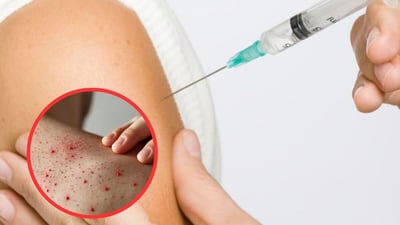 Brote de sarampión en México 2026: ¿Adultos mayores deben vacunarse?