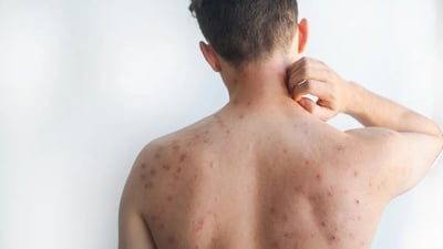 México mantiene altas tasas de vacunación contra el sarampión