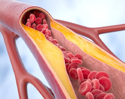 Puedes tener el colesterol bajo y estar en riesgo de infarto