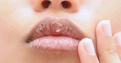 Labios resecos: Por qué se resecan y cómo cuidarlos