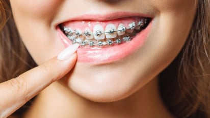 Brackets falsos, la nueva moda que pone en riesgo nuestra salud