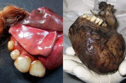 Teratoma: Notó que su vientre crecía y resultó ser un tumor con pelos y dientes