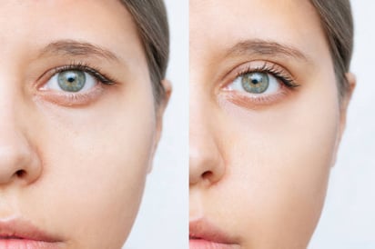 Párpados caídos: remedio natural y Como eliminar arrugas de los ojos