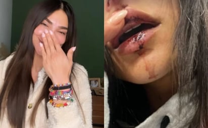 Tras aparecer con una parte del rostro ensangrentado, la conductora Alejandra Espinoza habla de su accidente: La también modelo dio a conocer la noticia a través de sus redes sociales