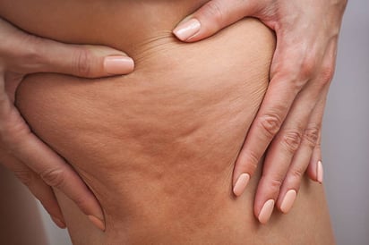 ¿Se puede prevenir la celulitis? 