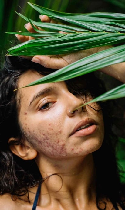 ‘Acne positivity’, la filosofía de amar los granitos de tu rostro