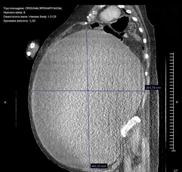 Extirpan un quiste de 5kg a una paciente: La paciente no imaginó que necesitara atención médica debido a su peso.