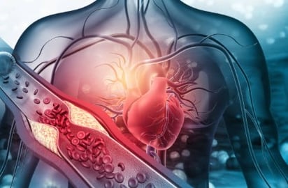 EVA: conoce esta enfermedad que afecta las arterias: Es responsable de infartos, accidentes cerebrovasculares y anginas de pecho, entre otras afecciones.