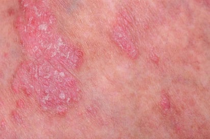 La vitamina D podría aliviar la psoriasis